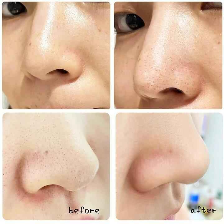 Blackhead Remover Pore Vacuum – Deep Cleansing Facial Suction Device