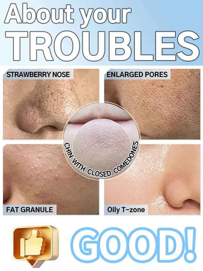 Blackhead Remover Pore Vacuum – Deep Cleansing Facial Suction Device