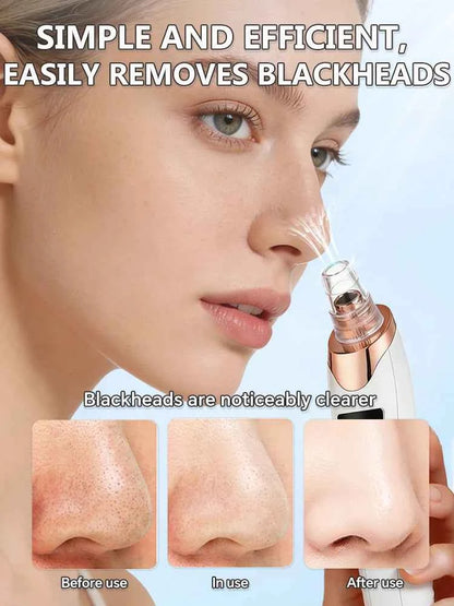 Blackhead Remover Pore Vacuum – Deep Cleansing Facial Suction Device