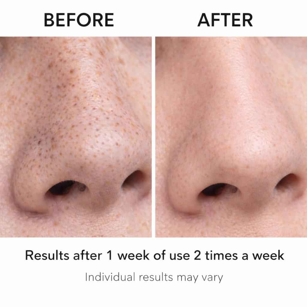 Blackhead Remover Pore Vacuum – Deep Cleansing Facial Suction Device