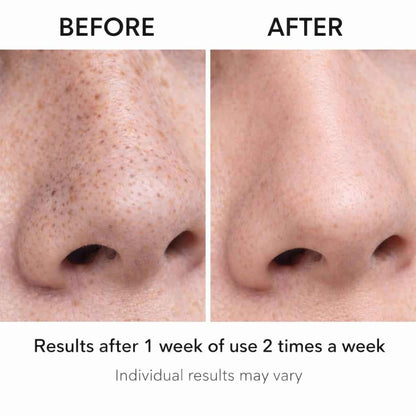 Blackhead Remover Pore Vacuum – Deep Cleansing Facial Suction Device