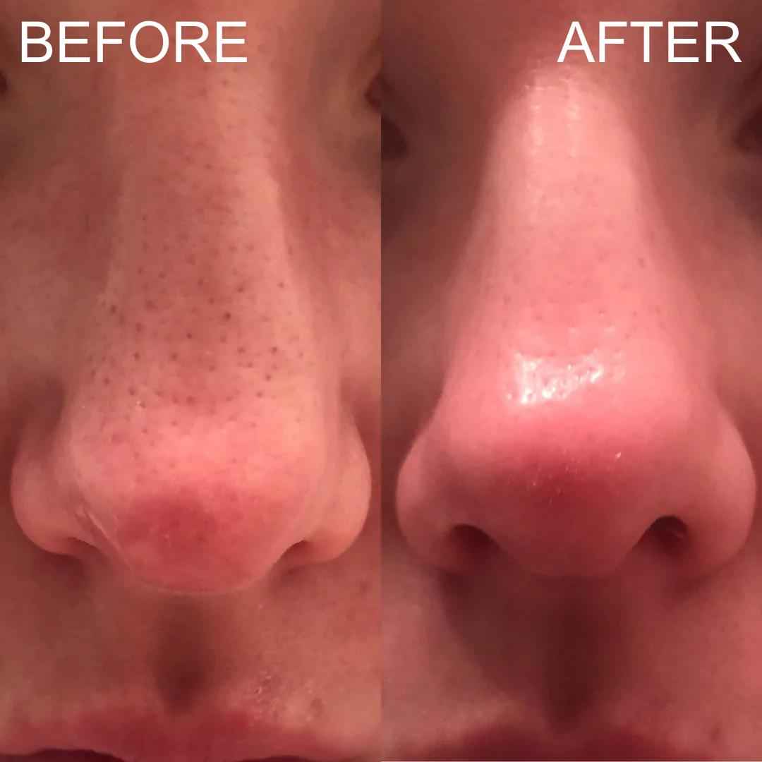 Blackhead Remover Pore Vacuum – Deep Cleansing Facial Suction Device
