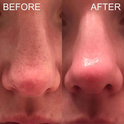 Blackhead Remover Pore Vacuum – Deep Cleansing Facial Suction Device