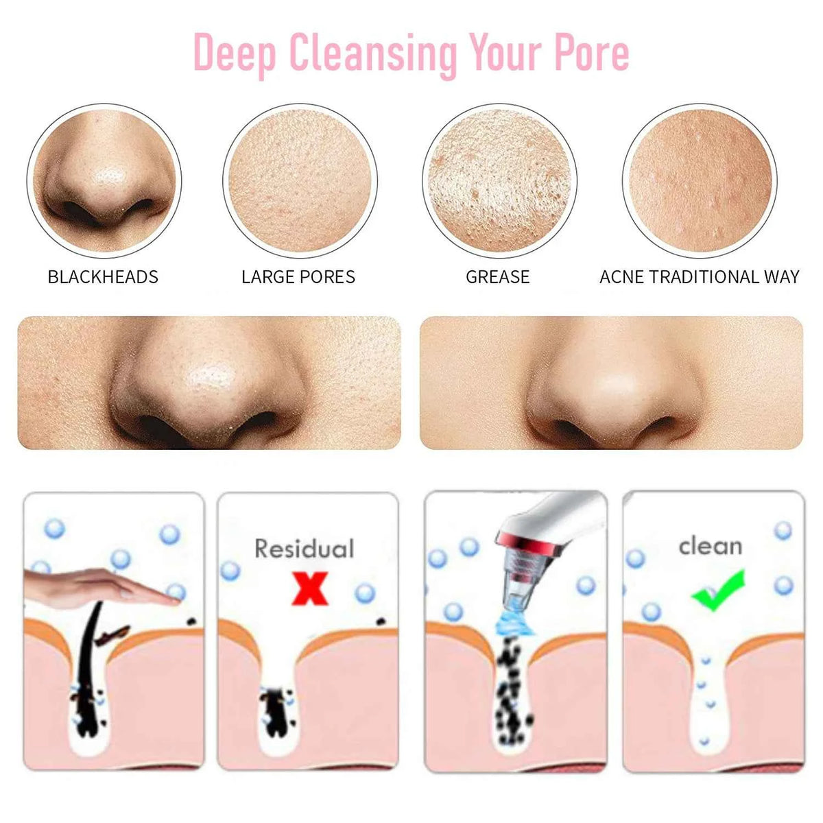 Blackhead Remover Pore Vacuum – Deep Cleansing Facial Suction Device