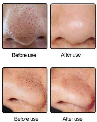 Blackhead Remover Pore Vacuum – Deep Cleansing Facial Suction Device
